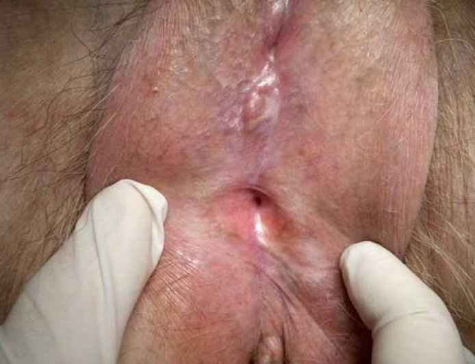 What is Lichen Sclerosis?